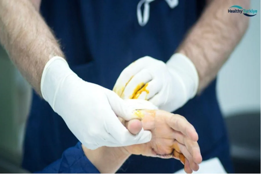 Hand Surgery in Turkey